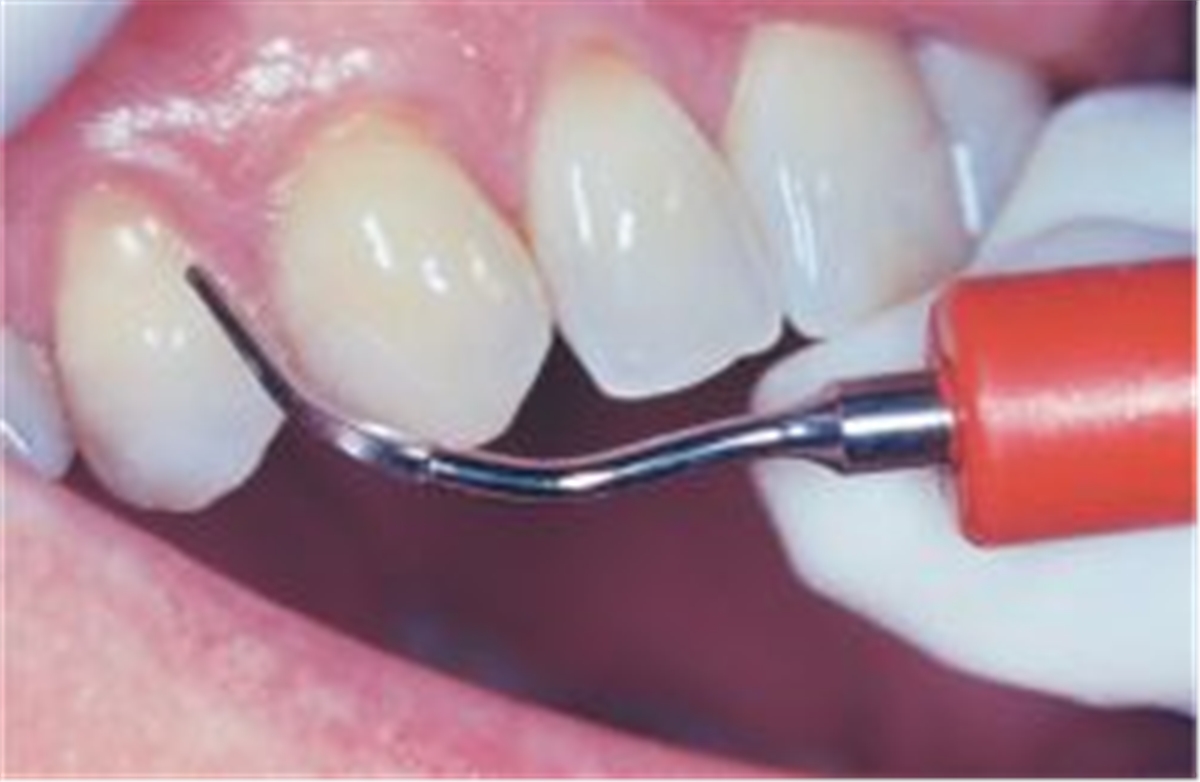 Zähne Skalierung und Polieren