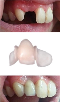 Mit dem CAD/CAM fehlenden Zahn ersetzen